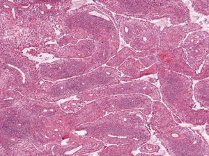 Grade 3 (Band): These widespread perivascular aggregates with dense interstitial inflammation extend between adjacent perivascular regions in a band-like manner.