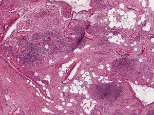 Grade 3: Many perivascular aggregates shown and focally extend into the interstitium connecting the perivascular regions.
