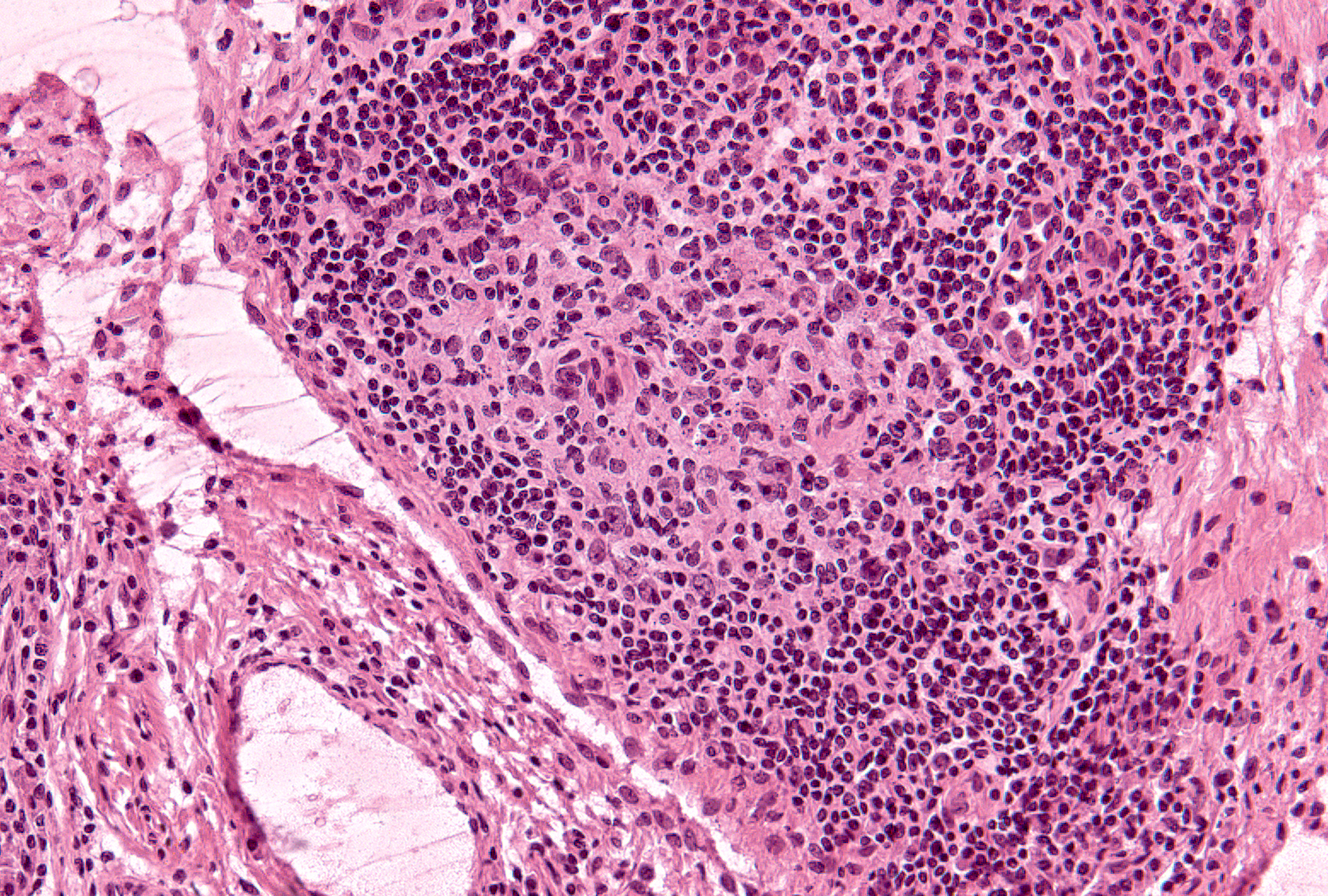 Grade 1 (present), Example 1: The pale zone of cells in the center represents a germinal that is nearly completely surrounded by small lymphocytes.