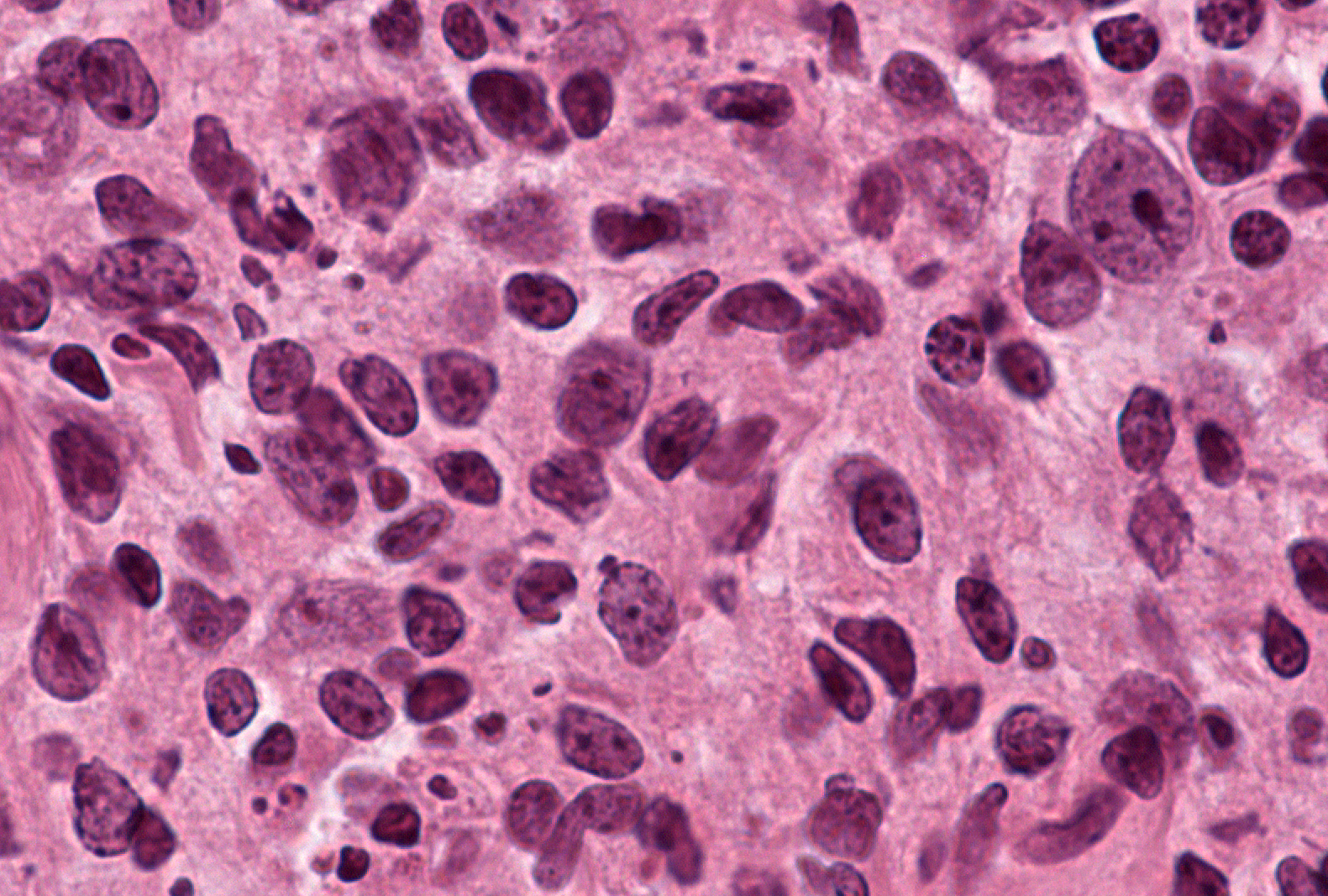 Grade 1 (present), Example 2: The mixture of small and large lymphoid cells typical of a germinal center show irregular sizes and shapes with and without nucleoli are visible with small particles of tangible bodies.