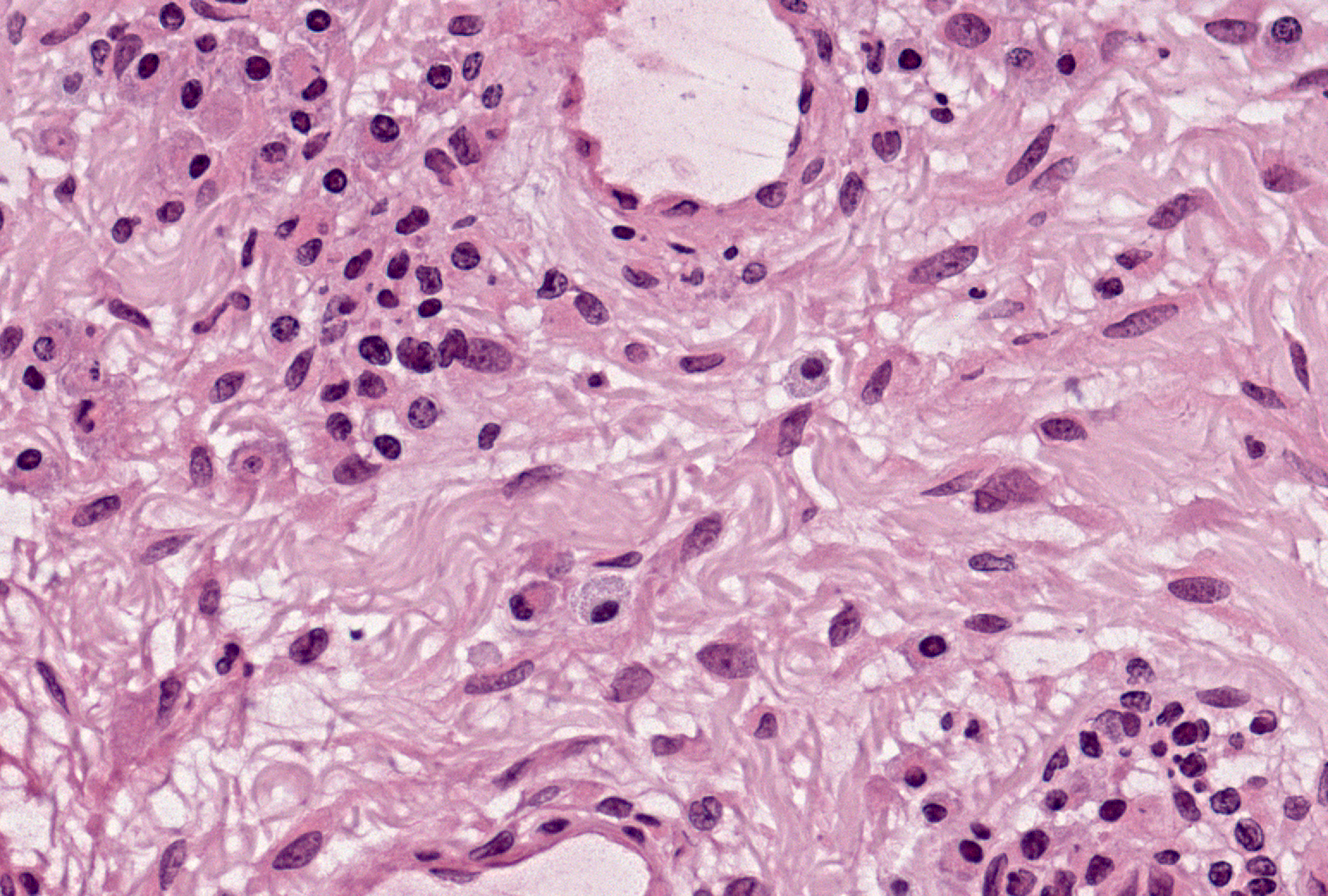 Mast Cell: Mast cells have a single oval nucleus placed centrally or peripherally within cytoplasm that has fine blue-staining granules. This image has at least 3 mast cells (2 in the center and 1 in upper left corner). Granular plasma cells may mimic mast cells.