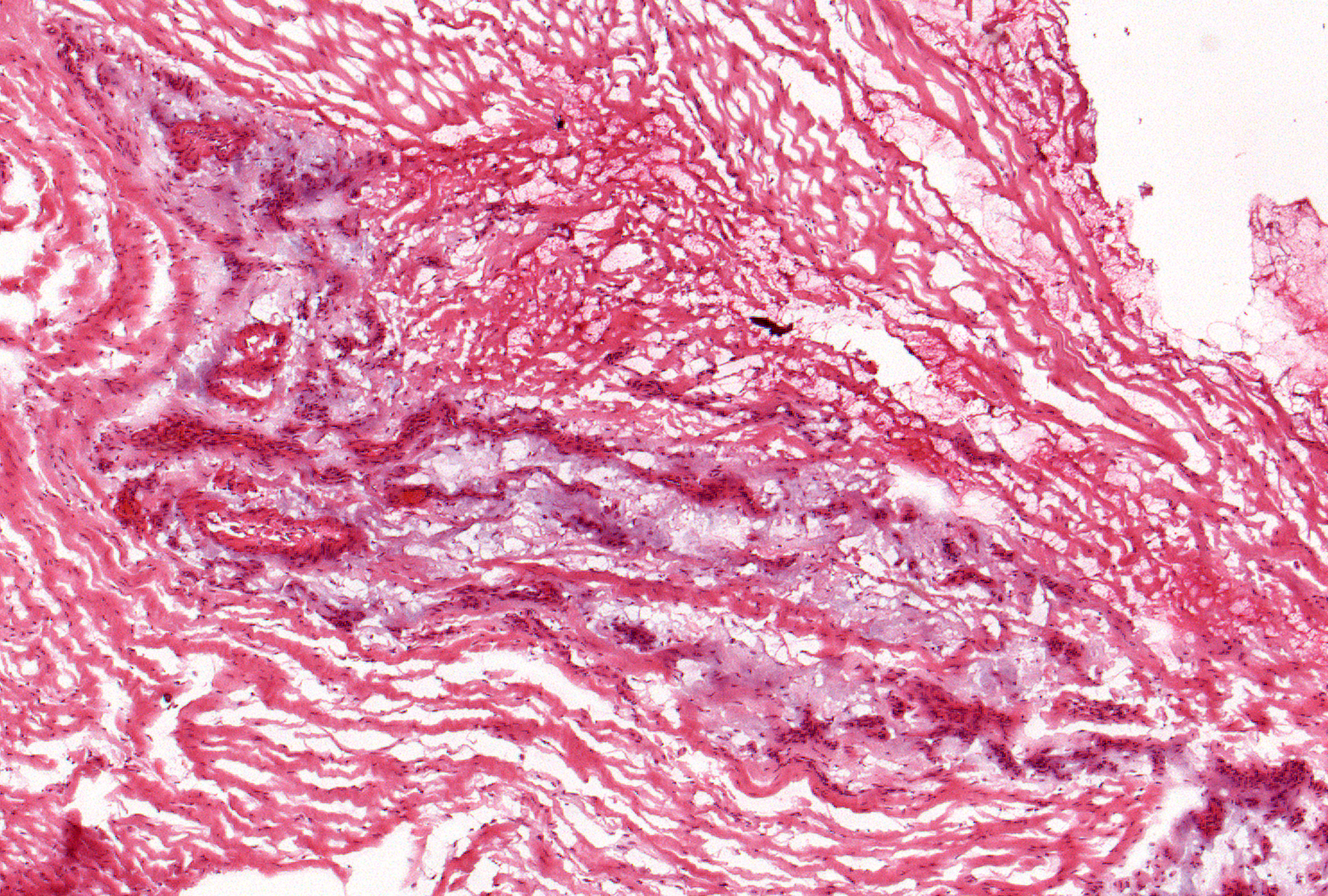 Grade 1: The lowest degree of mucoid change appears around blood vessels with little extension beyond the vascular web.