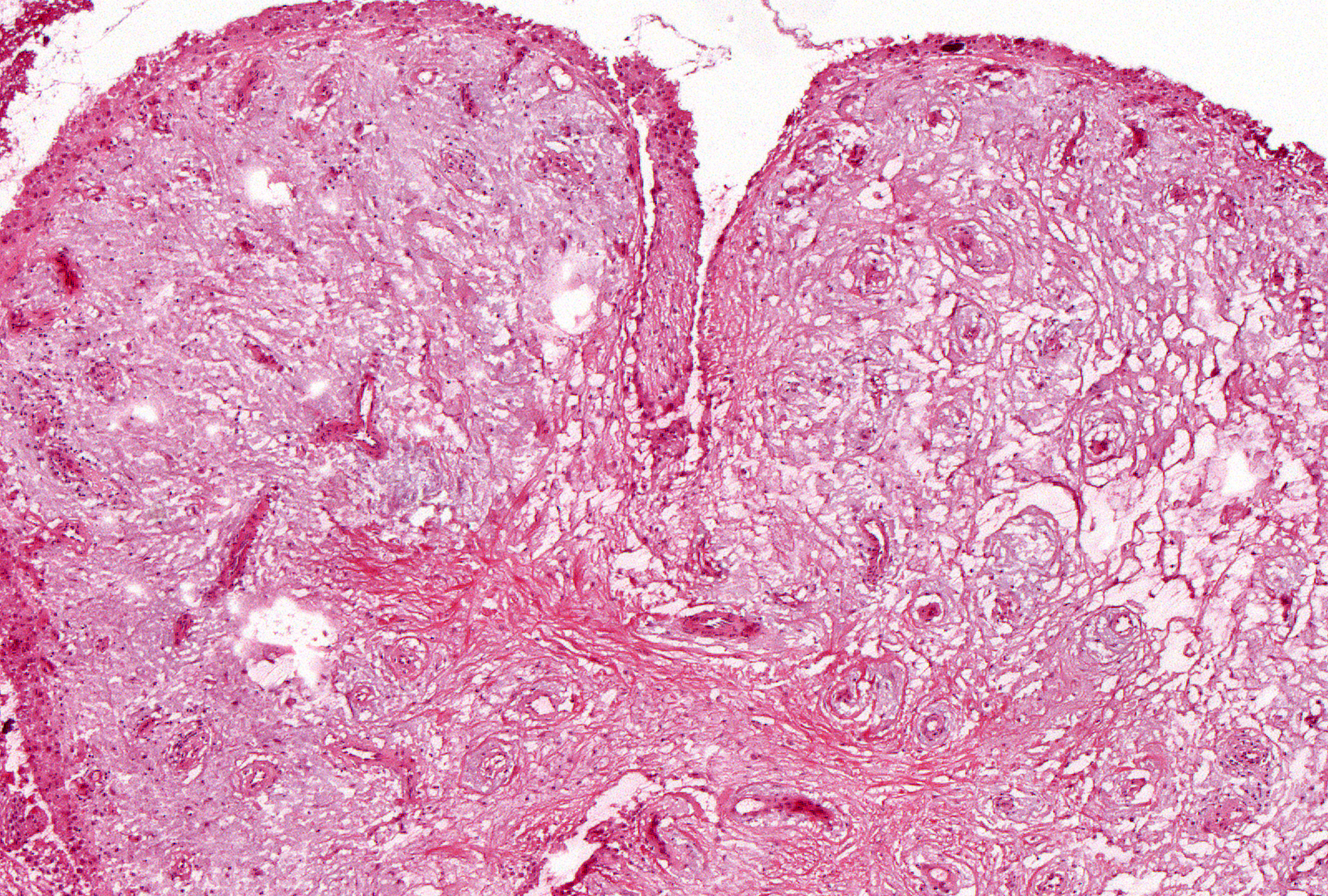 Grade 3: The mucoid change in this grade becomes more widespread and, like interstitial fibrosis, tends to replace synovial fat and obliterate the synovial architecture.