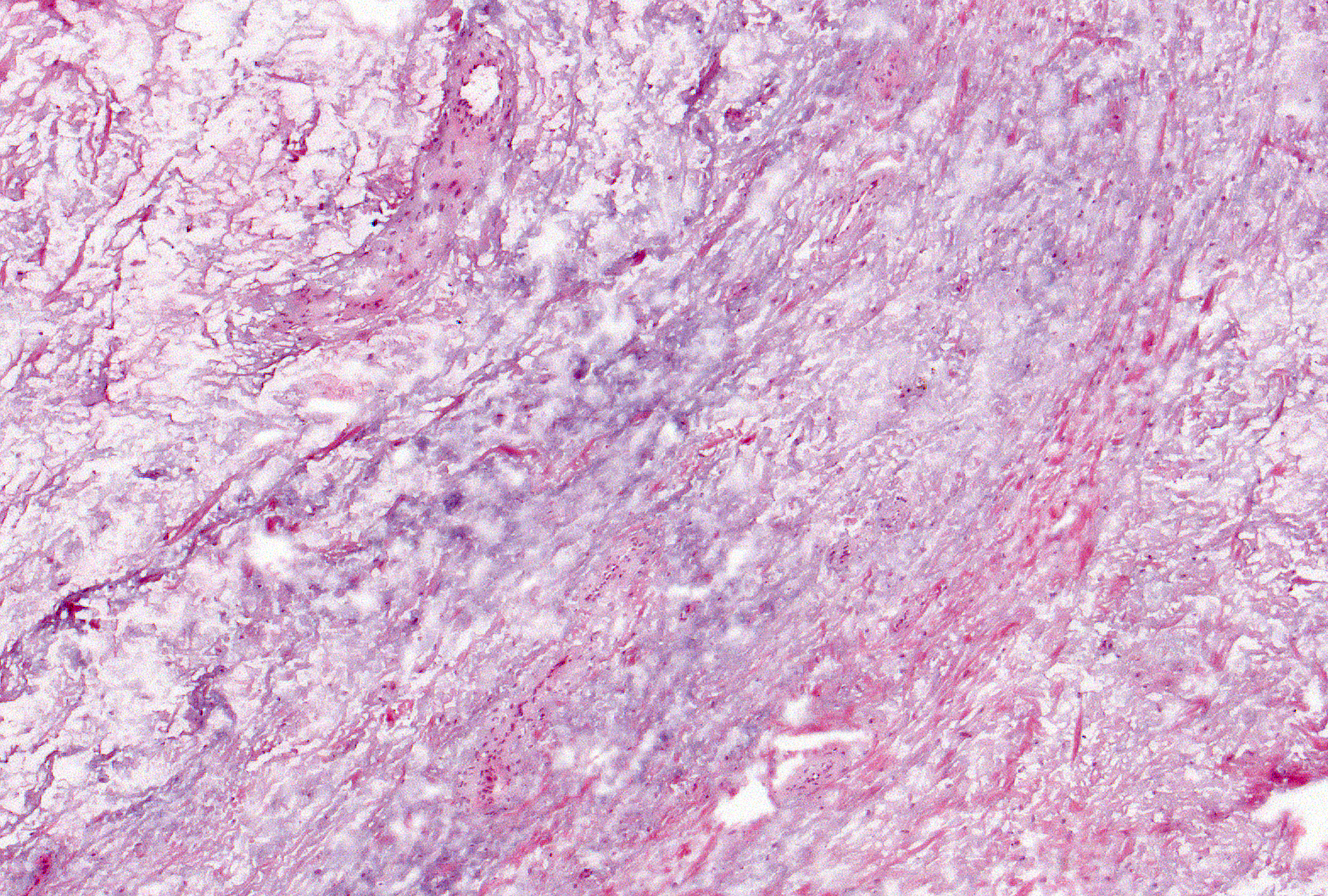 Grade 4: Myxomatous mucoid change appears as a field of material that obliterates the synovial architecture and appears as cells (sometimes angular and stellate) suspended in amorphous, bluish matrix supported by delicate collagenous (pink) stroma. This imparts a jelly-like quality to the gross tissue.
