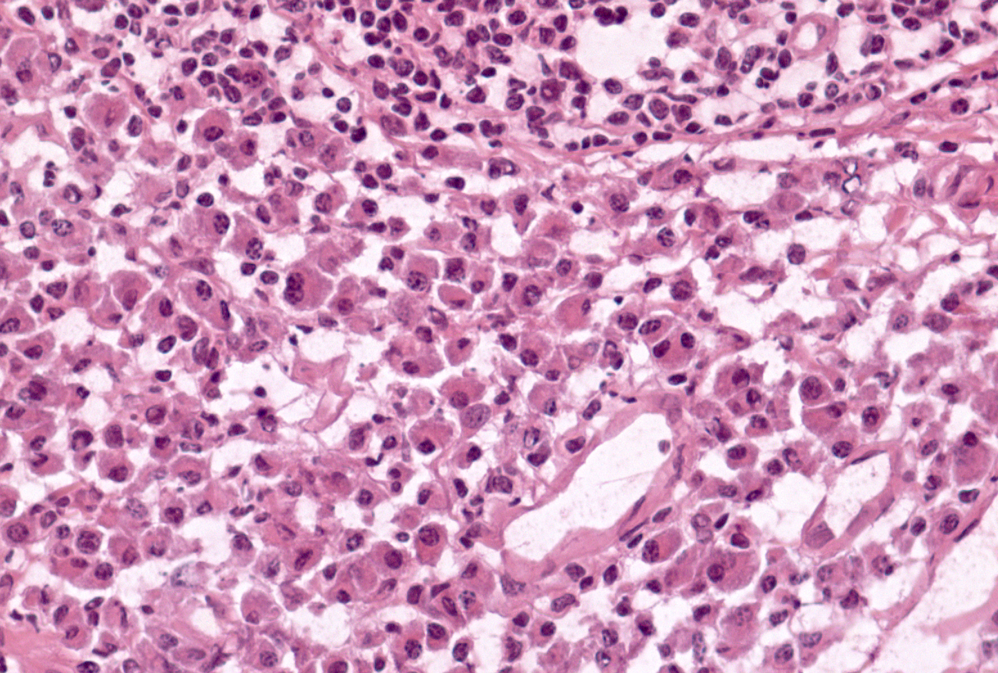 Multinucleate Plasma Cell: Plasma cells that contain 2 nuclei are visible to the left and right of center in this sheet of plasma cells and have typical nuclear morphology. Large cells with 3 or more nuclei may also be seen in other cases.
