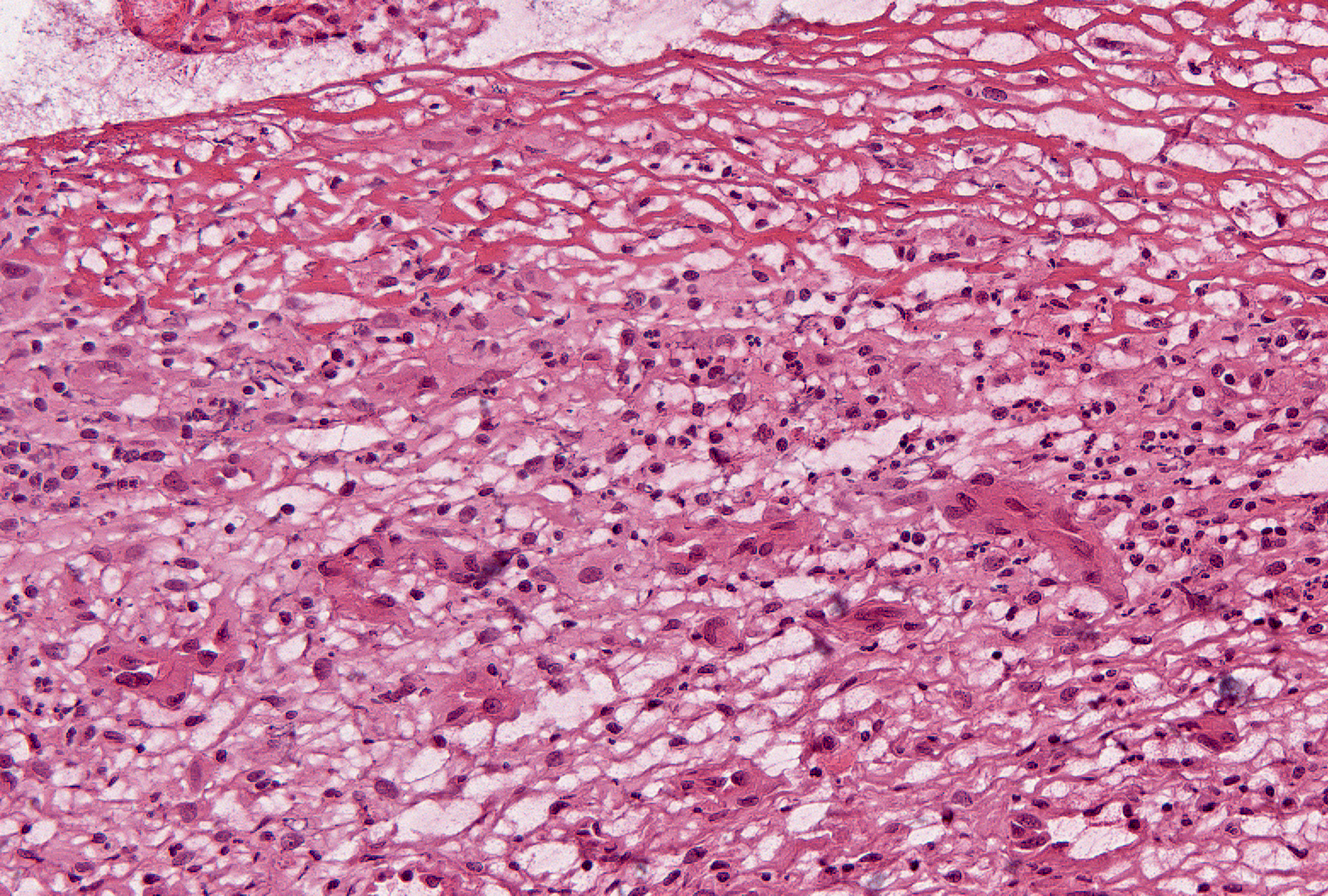 Neutrophils: The neutrophils in this image are at the base of fibrin, but may be seen in the lining layer, and are not associated with necrosis. In granulation tissue, their presence may be indicative of infection.
