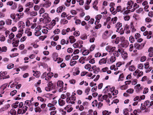 Grade 1: Example A: Plasma cells at the upper and upper right edges of this collection of lymphocytes represent just barely more than approximately 10% of the lymphoid cells.