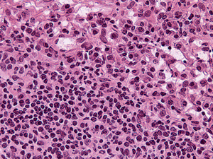 Grade 0: The cells are mostly small lymphocytes with a few plasma cells at the periphery, seen best at the top right edge.