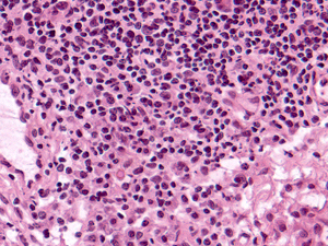 Grade 1: Example B: Plasma cells, especially in the lower left of this image, make up nearly half of the lymphoid cells in this collection.