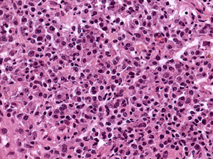 Grade 2: Plasma cells constitute the majority (>50%) of the lymphoid cells in this image. Lymphocytes can be seen in the upper left of the image.