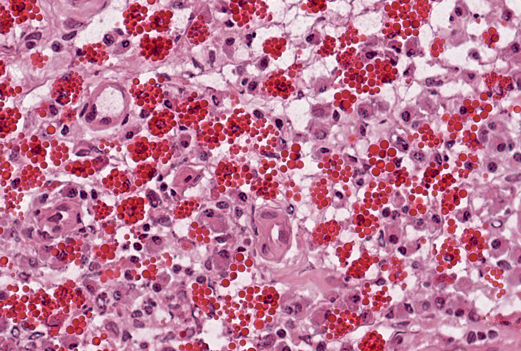 Grade 1 (present), Example 1: Russell bodies may be seen as multiple red beads within individual plasma cells (seen in the background) and free in the tissue.