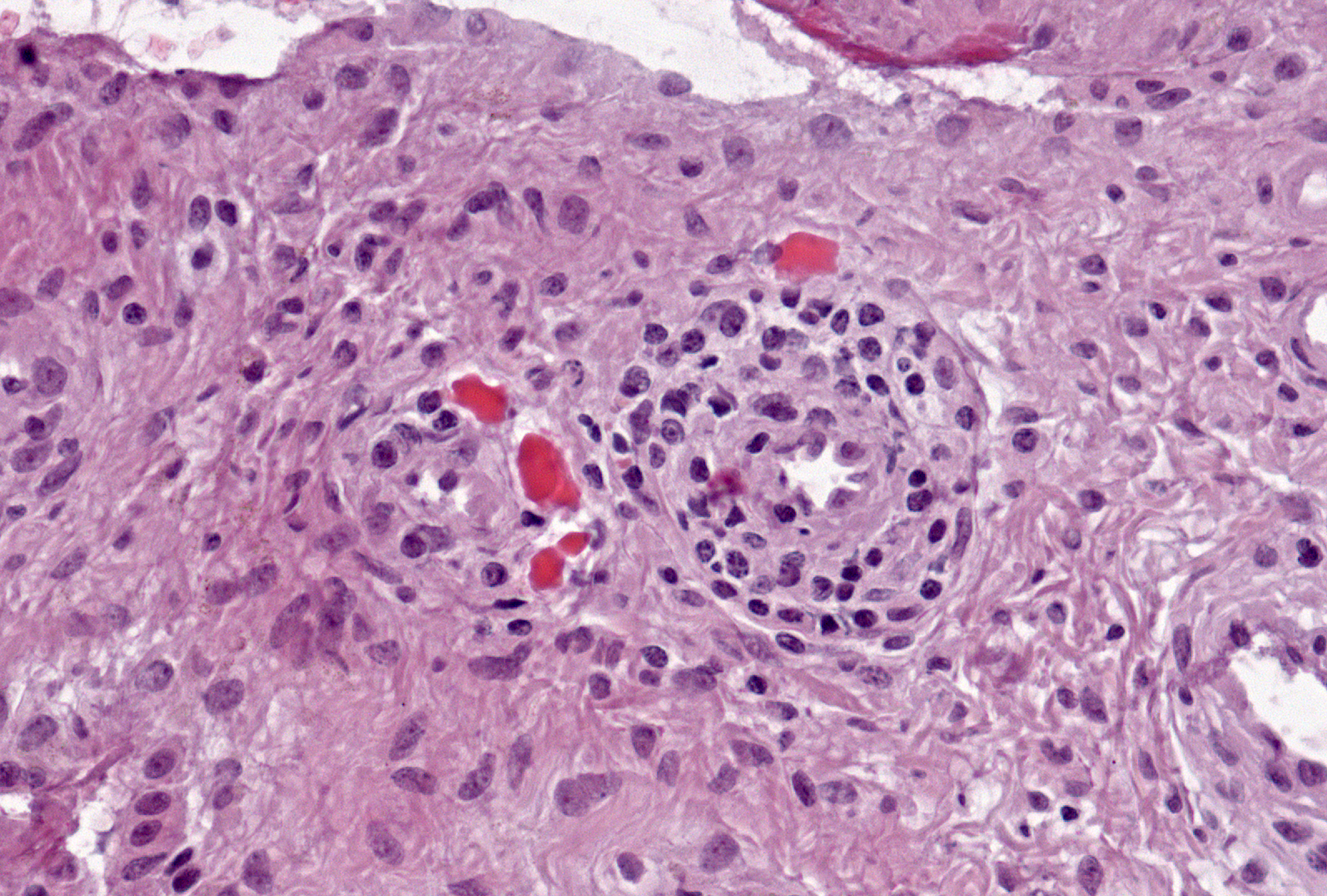 Grade 1: (present), Example 2: Russell bodies may be seen as red irregularly shaped structures or beads free in the tissue.