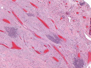 Grade 2: Five identifiable perivascular aggregates with slight interstitial spread are shown in this image. Other fields had no more than this number of aggregates.