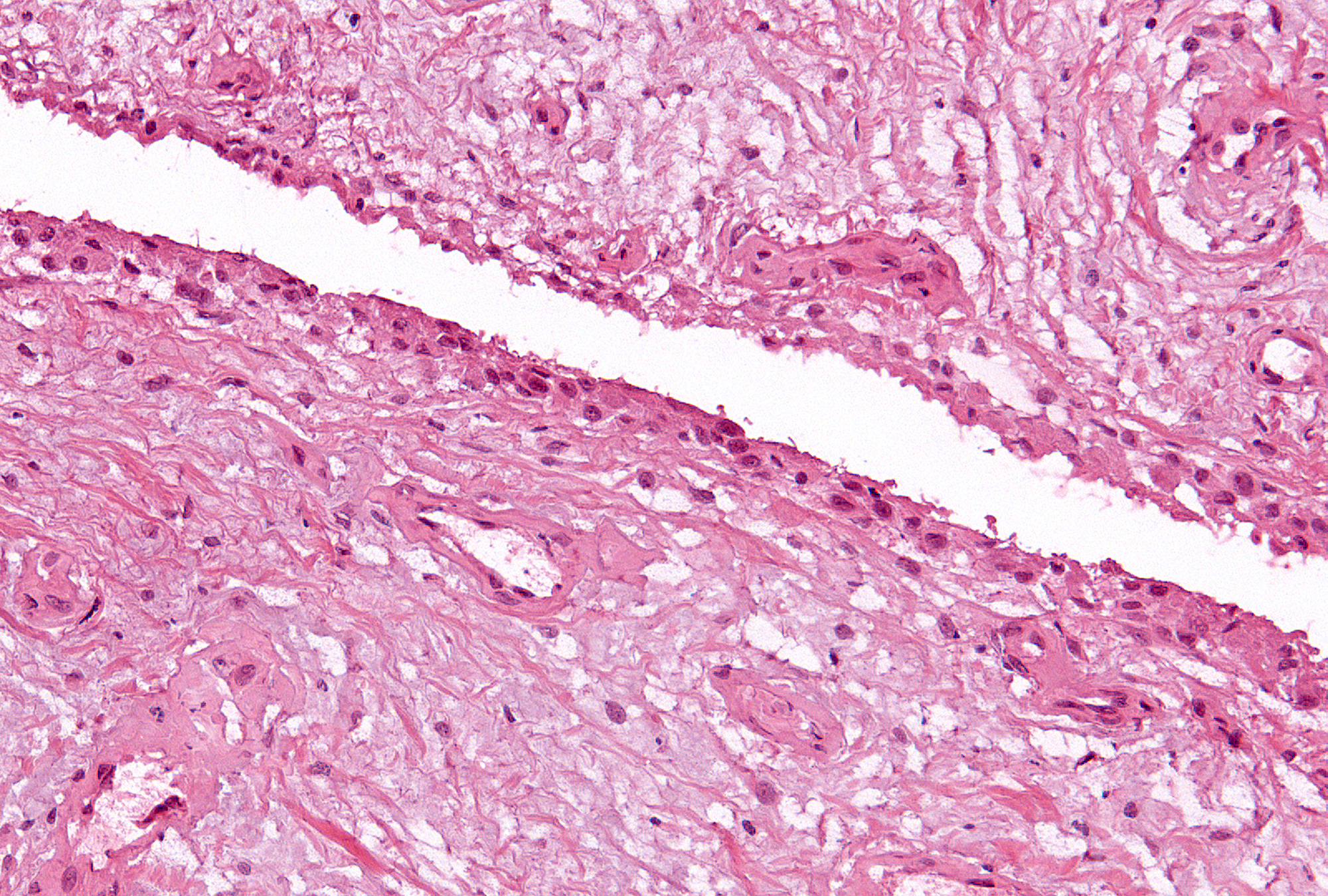 Grade 1: The condensation of cells at the 2 surfaces visible in this field ranges from 1 up to 3 cells thick, providing the lowest level of ‘hyperplasia’ discernible in a tissue section.