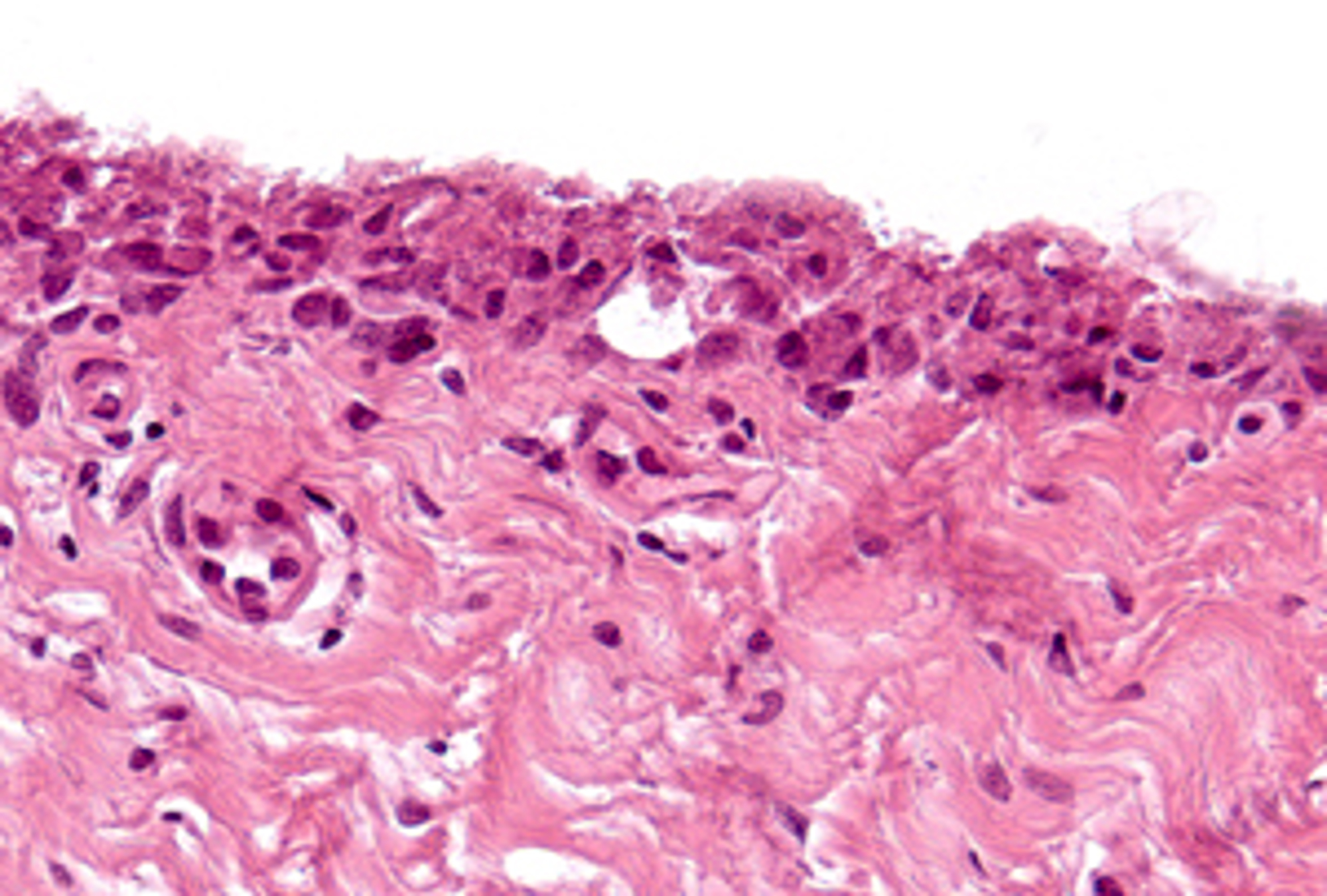 Grade 2: The synovial lining in this image is thicker than grade 1 but is consistently between 3 and 4 cells thick. Overlapping and bunching up can be appreciated as well.