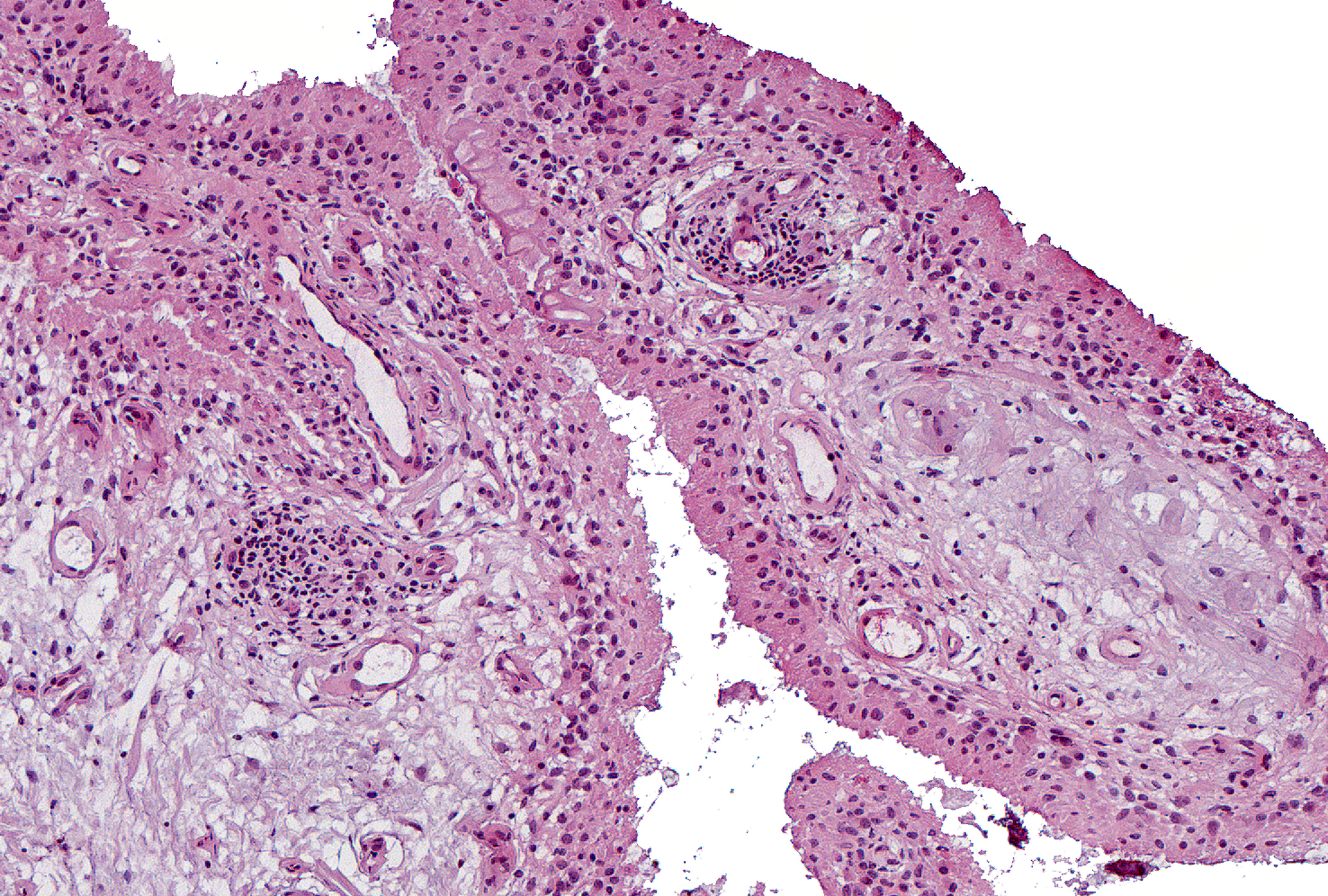 Grade 3 Example 1: The 2 surfaces in this field show more than 4 cells, with less defined lower borders and larger cells at the surface, indicating a highly reactive lining layer.