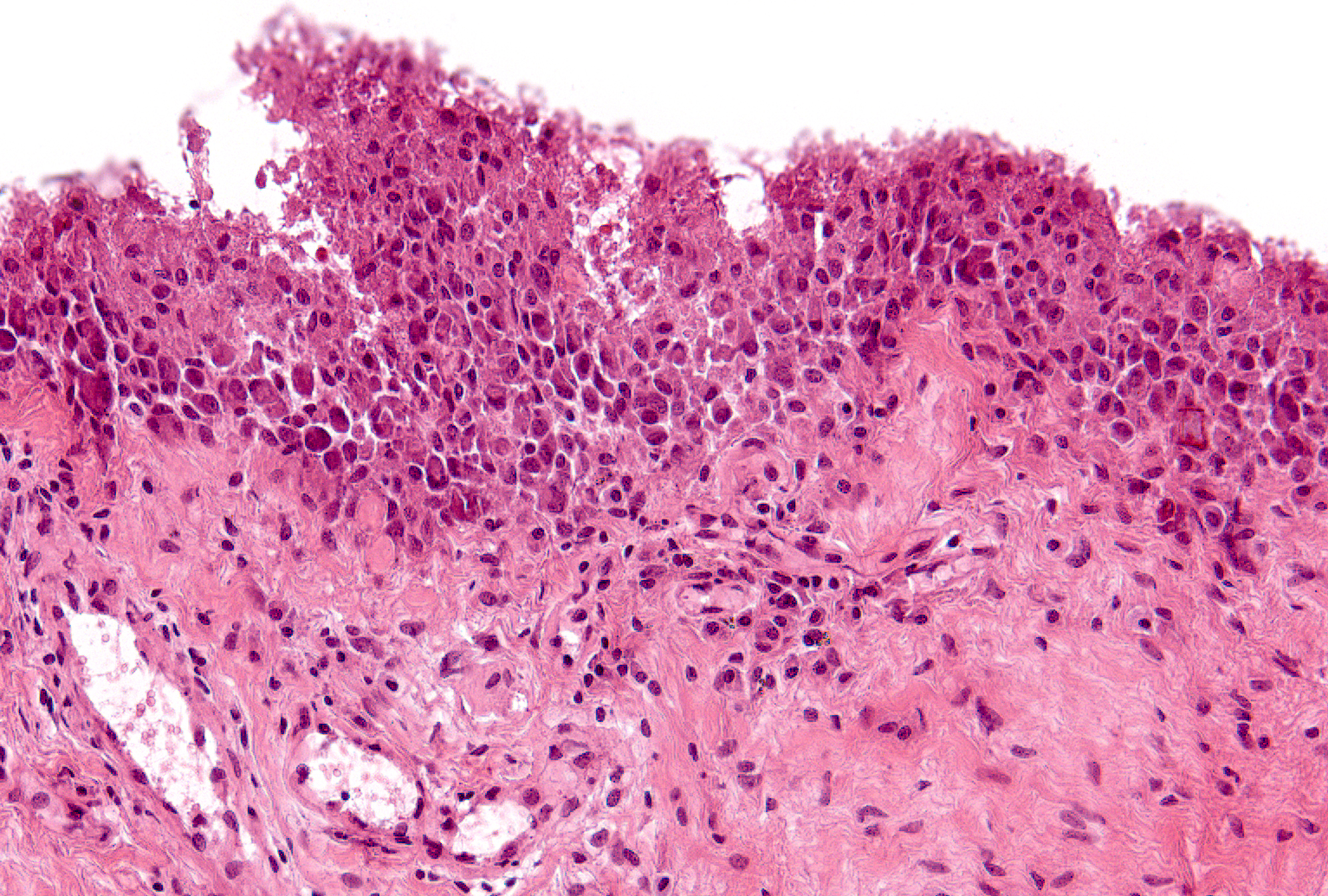 Grade 3 Example 2: The lining layer in this field is remarkably thick due to tangential sectioning which results in the appearance of sheets of synovial lining cells instead of a discernible layer. Due to angle of sectioning, it is possible to make a layer look thicker than it is, but not thinner.