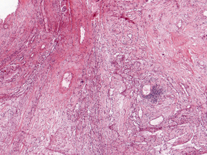 Grade 1: A single perivascular aggregate is shown in this image. No other field had more than this; many had less.