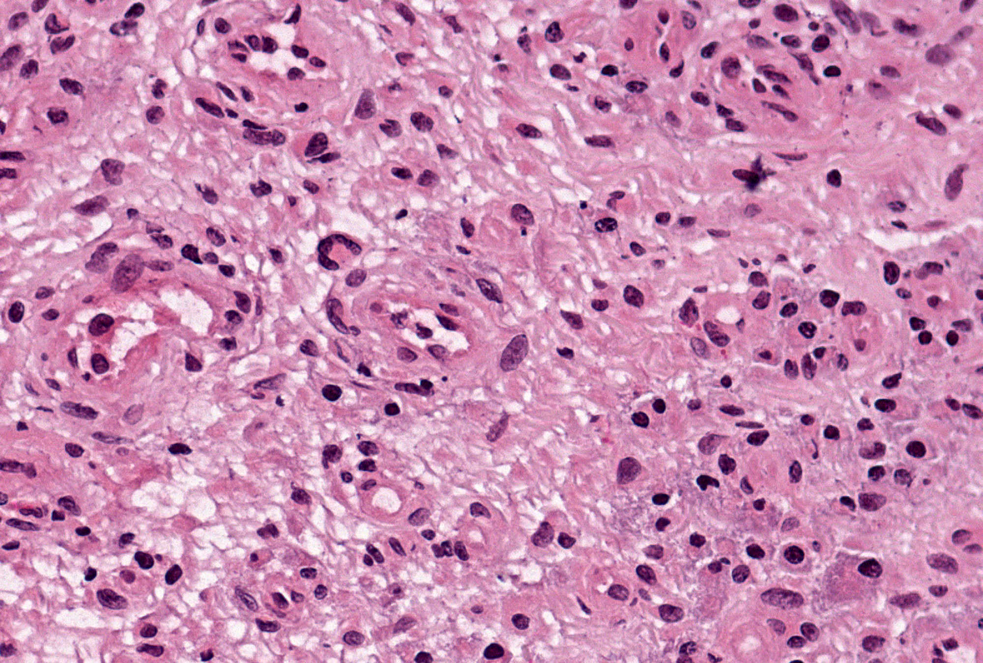 Stromal Giant Cell: One large cell with a c-shaped group of 4 nuclei is apparent in this image of hypercellular stroma.