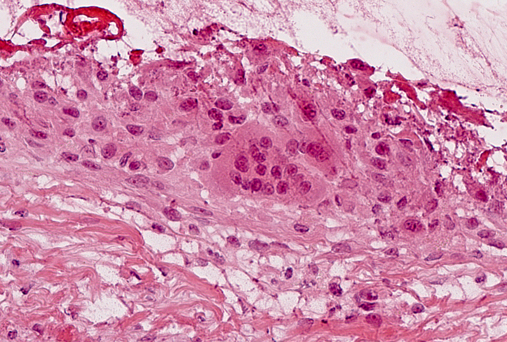 Grade 1 (present), Example 1: A large giant cell containing many centrally located nuclei is present in the center at the base of this thickened lining layer; a small giant cell is present to the immediate upper right of the first giant cell.