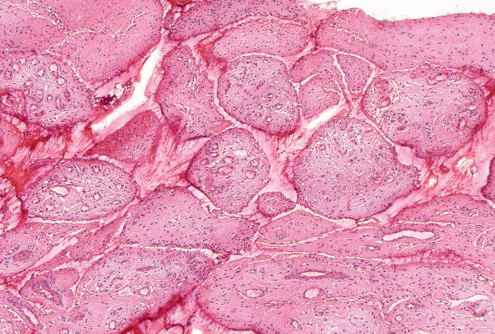 Increased vascularity can only really be appreciated by comparison with other regions in the section. Small vessels distributed in clusters impart a hypervascular appearance.